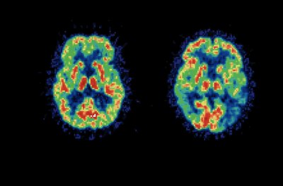 PET brain scan result comparison