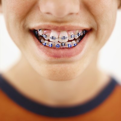 A close up a of a young boys braces.