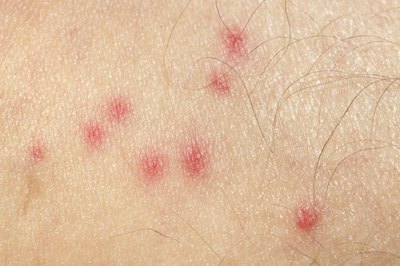 Bug bites on skin.