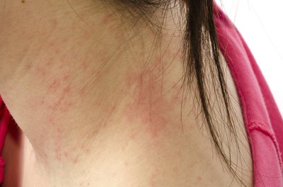 Young woman with a rash on her neck
