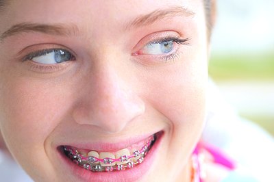 How to Get Free Braces