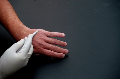 Wart removal from hand.