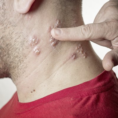 Shingles is a rash due to the virus that causes chickenpox
