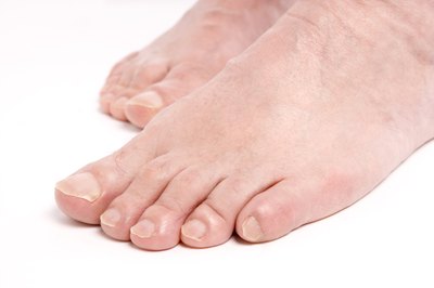 Athlete's foot