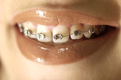 Best Way to Whiten Teeth With Braces