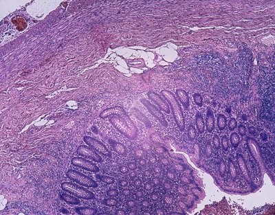 Microscopic image of a inflamed appendix