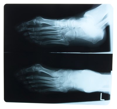 The middle area of the foot is composed of five bones.