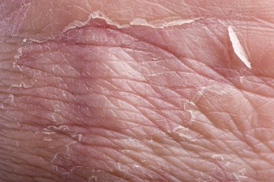 Dermatitis includes skin slaking.