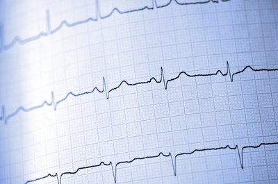 EKG reading