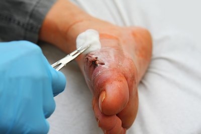 A bunionectomy may be covered under your insurance.