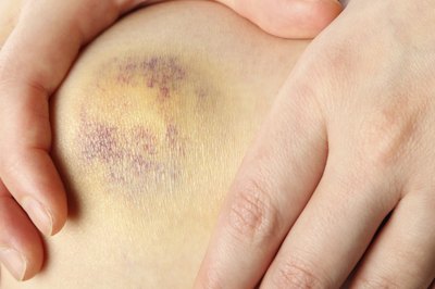 Skin discoloration.