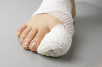 Foot wrapped after surgery