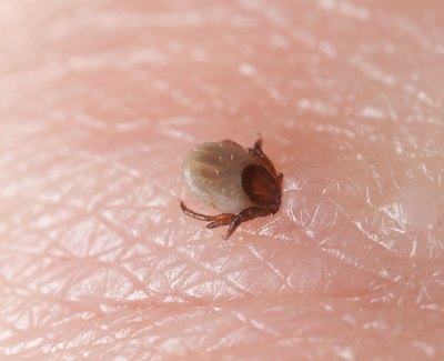 Reddened skin with tick.