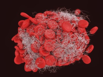A 3D close up of a vein thrombosis