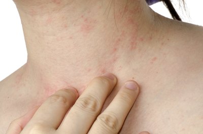 Young individual with an allergy rash