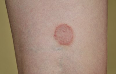 Elena Stepanova/iStock/Getty Images Ringworm becomes more serious if bacteria infect the skin lesions.