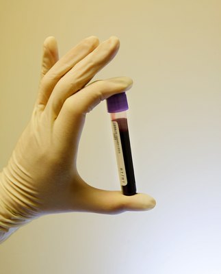 Thinkstock/Stockbyte/Getty Images Simple blood tests can confirm hyperlipidemia and its potential underlying cause.