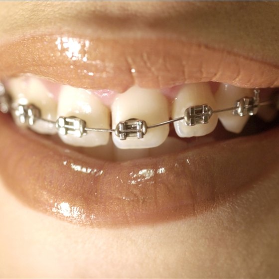 How to Prevent White Spots From Braces Healthy Living
