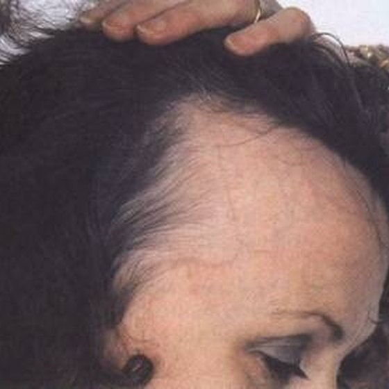 about-receding-hairlines-in-women-healthy-living