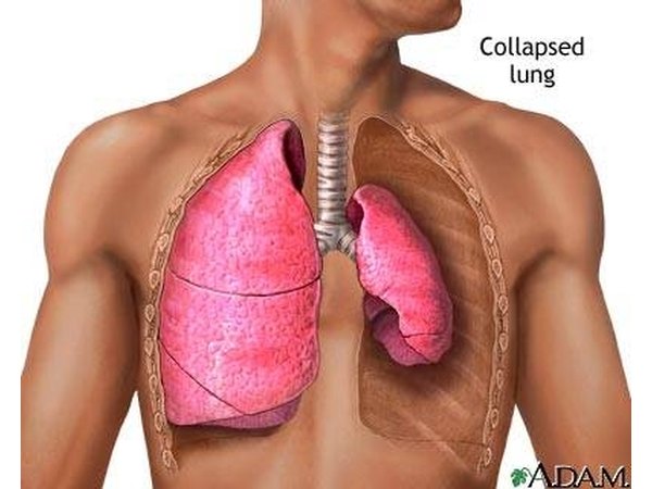 Pneumothorax: One of the Causes of Shortness of Breath