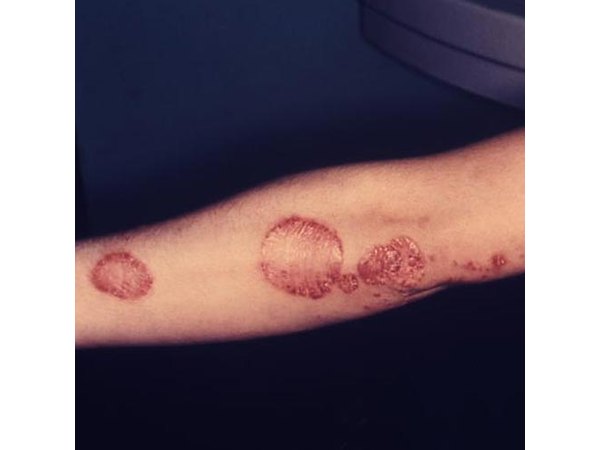 Psoriasis is characterized by scaly skin over the affected areas
