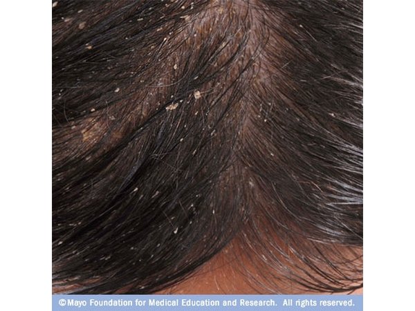 Seborrhoeic Dermatitis looks like dandruff, but can cause a more serious rash or scaling of the skin