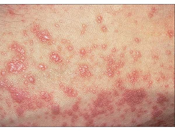 Lichen planus is characterized by what looks like red, mucus-filled bumps on the scalp