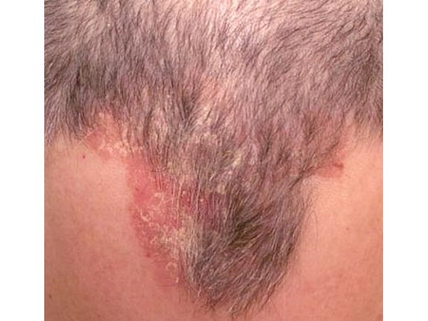 Scalp acne is caused by the build-up of dirt and bacteria under the hair