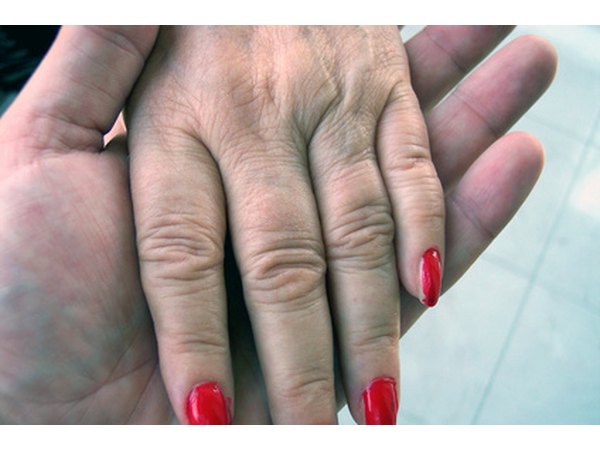 Dupuytren's Disease may also cause thickening on top of the knuckles.
