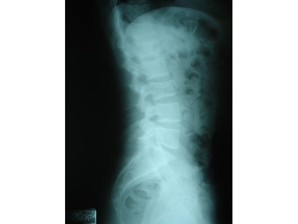 Most bulging discs occur in the lumbar spine.