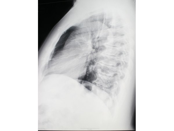 An MRI will reveal no tear in the annulus of a bulging disc.