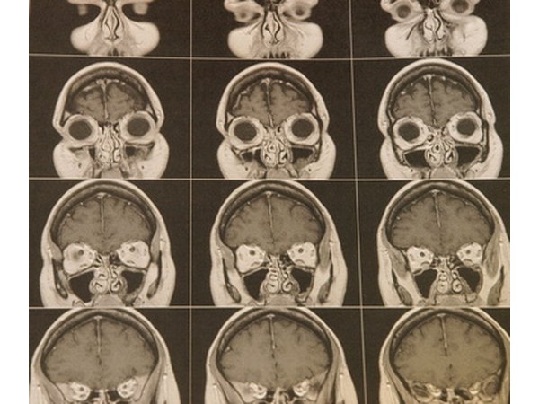 PET scans reveal dopamine centers differ in thrill-seekers.