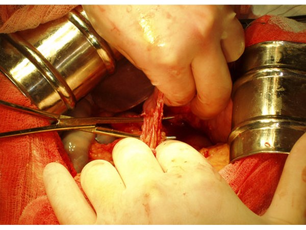 Mesh can sometimes cause organs to adhere to one another