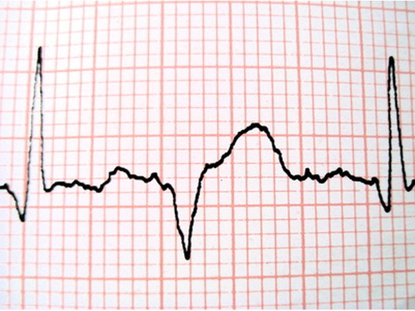 EKG tests provide additional data about heart functions.