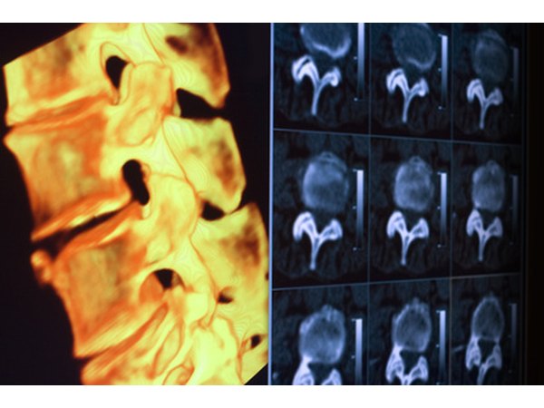 A side view MRI can reveal a difference in vertebrae spacing with a bulged disc.