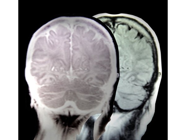 Untreated hypertension can damage the brain and other organs