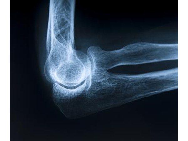 Ewing's sarcoma affects the shaft or middle part of large bones in the upper arm.