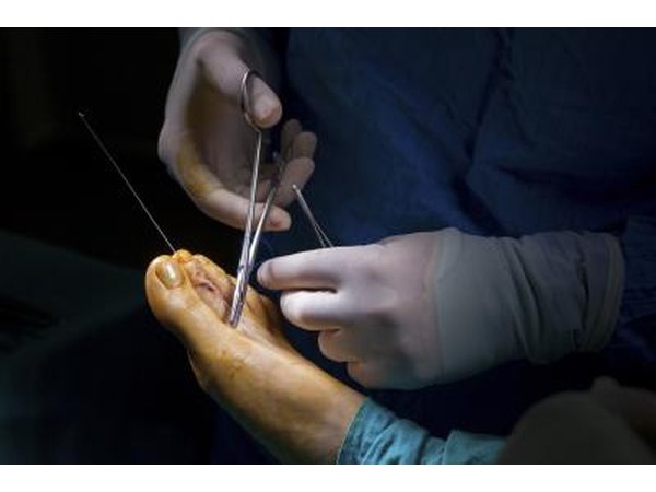 Patients have a success rate for plantar fascia surgery as high as 70 to 90 percent.
