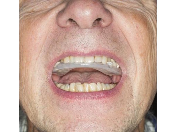 Invisalign braces.