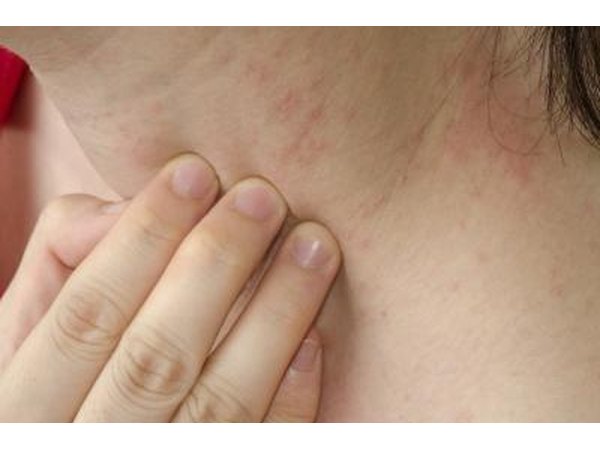 Chlorella can be made into a paste and used to treat eczema.