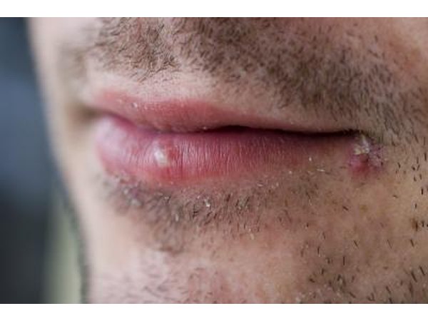 Man with sores on mouth