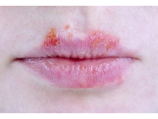 Herpes healing.