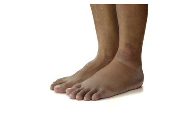 Swelling is another sign of torn cartilage.