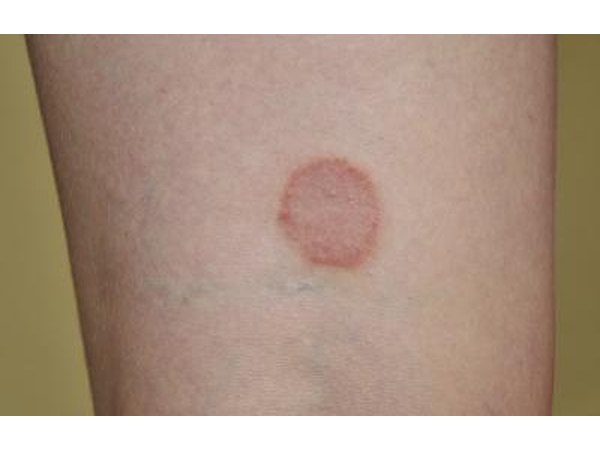 Ringworm and jock itch are a type of dermatophytes.