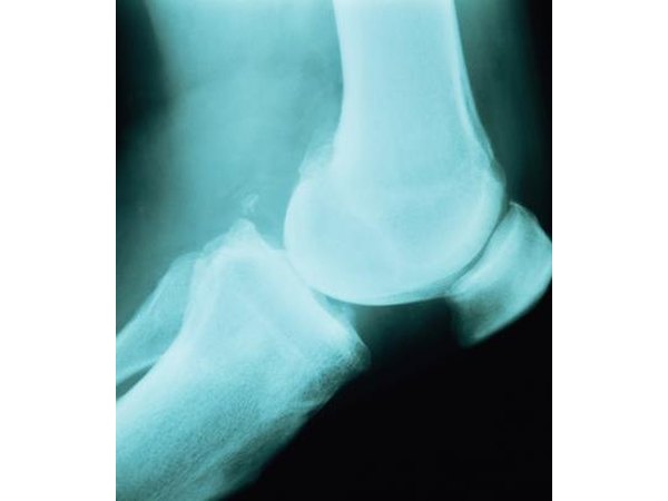 X-ray of knee.