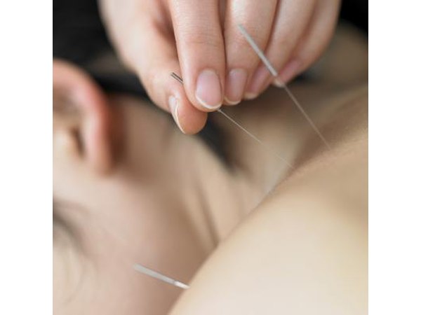 Women receives acupuncture treatment