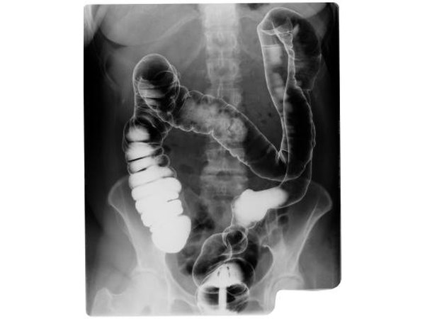 X-ray of human intestines