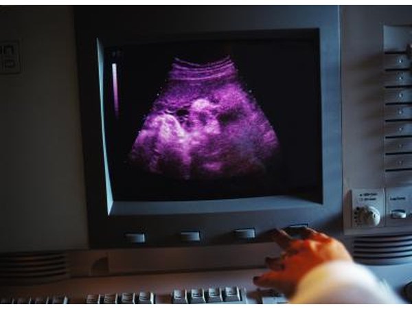 Interpret the code 76805 as presence of one fetus in the gestational sac in the post-first trimester period.