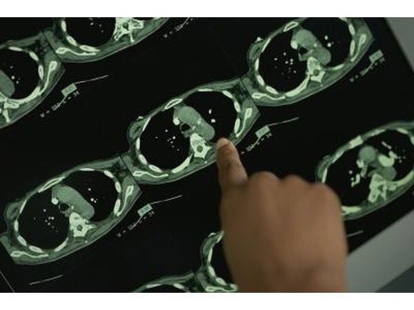 MRI scans