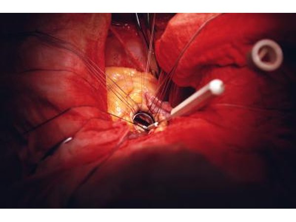Open Heart Surgery